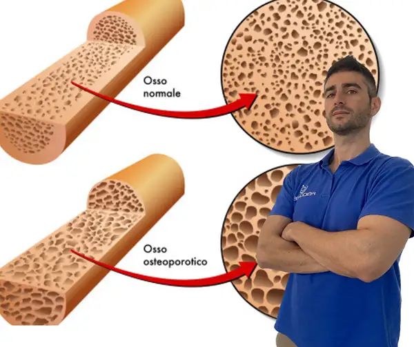 Osteoporosi