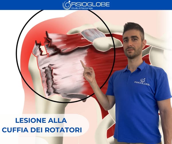 Cuffia dei rotatori: lesione e trattamento fisioterapico