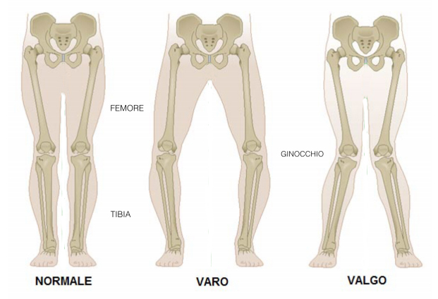Ginocchio valgo: esercizi e terapie per correggerlo