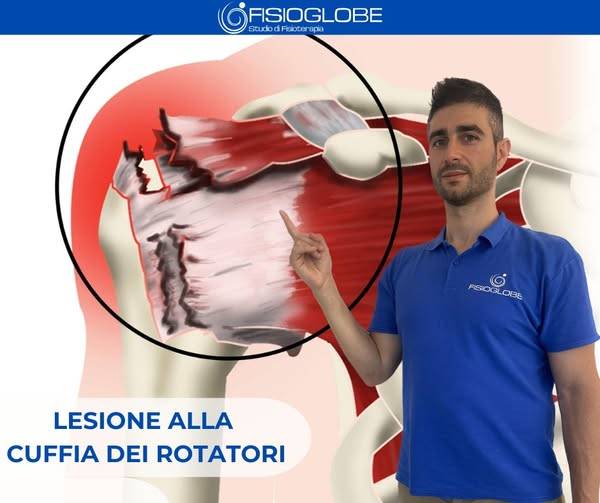 Lesione cuffia dei rotatori
