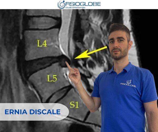 Ernia del disco: trattarla con la fisioterapia