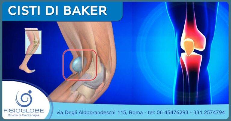 Cisti di Baker al ginocchio: cause, sintomi e soluzioni
