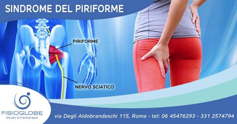 sindrome dei piriforme