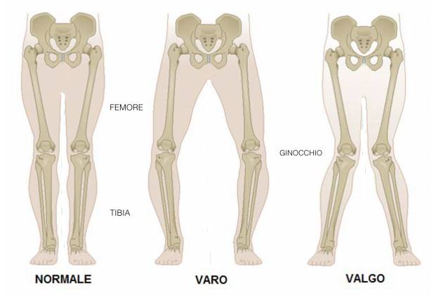 Ginocchio valgo: esercizi e terapie per correggerlo