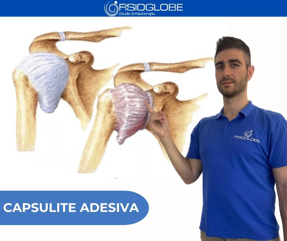 Capsulite adesiva alla spalla: cos&rsquo;&egrave; e come agire