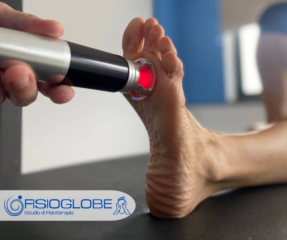 Neuroma di Morton, cos'&egrave;, sintomi e trattamenti