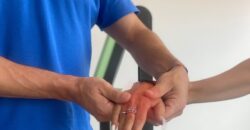 Artrosi della mano, cosa è e trattamenti
